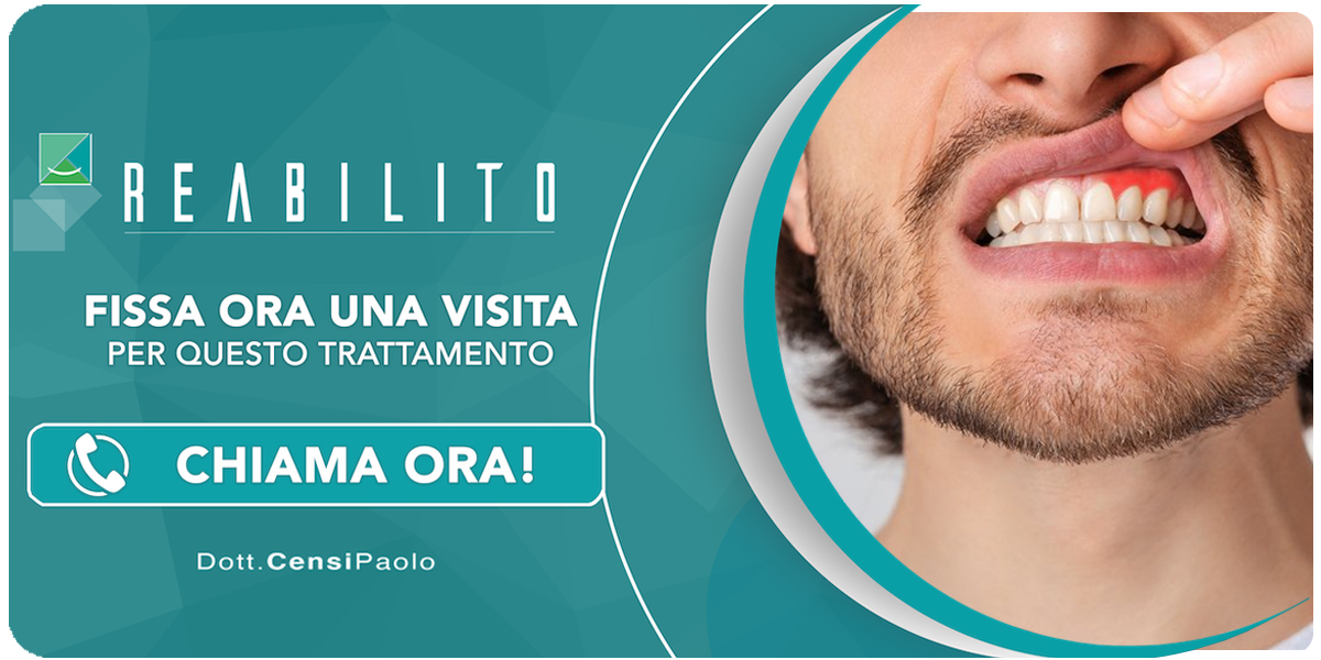 recessione-gengivale Anzola dell'Emilia (Bologna)